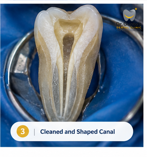 Prepared root canal