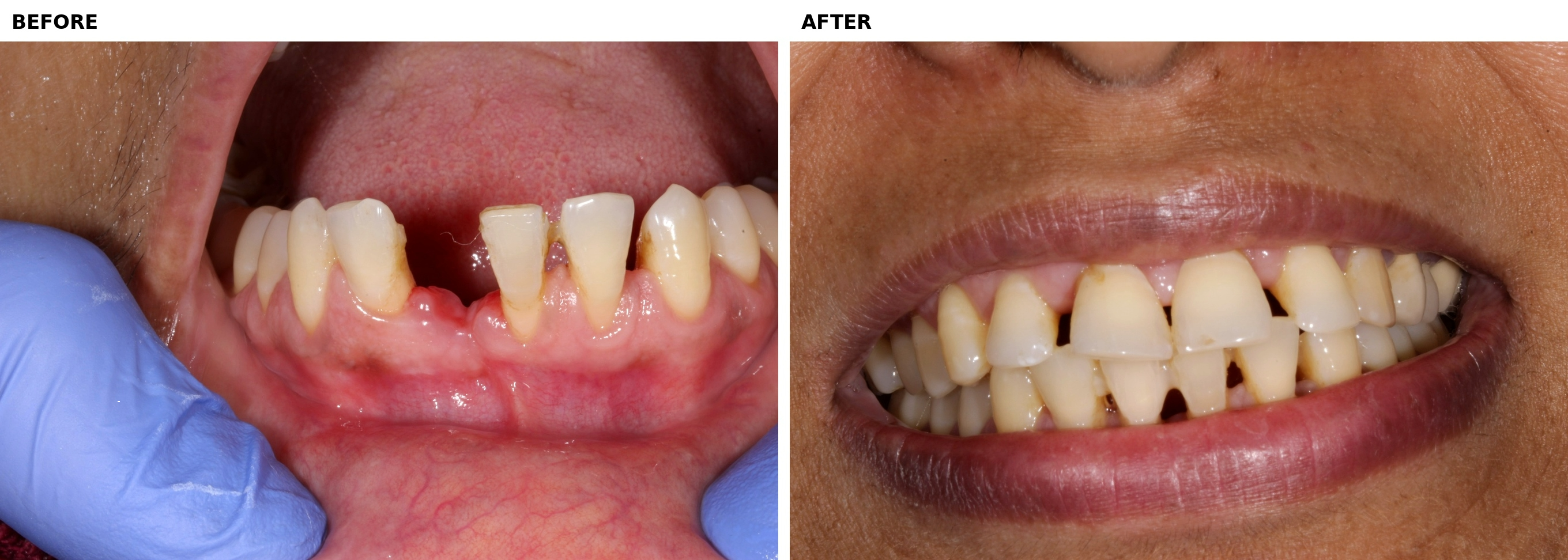 Replacement of missing teeth